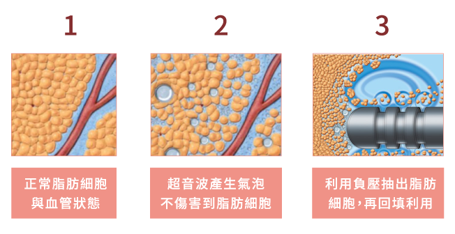 晶華醫美抽脂體雕手術能將脂肪乳化、降低出血量。