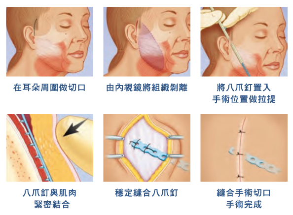 台北、桃園晶華醫美臉部拉皮整形手術推薦 內視鏡隱痕拉提手術