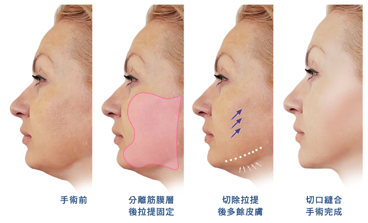 台北、桃園晶華醫美臉部拉皮整形手術推薦 內視鏡隱痕拉提手術