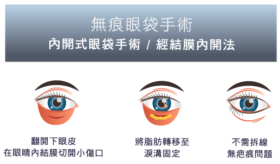 台北、桃園晶華醫美眼袋整形手術推薦 無痕內開眼袋手術
