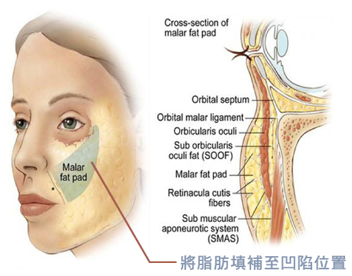 台北、桃園晶華醫美眼袋整形手術推薦 自體脂肪補脂