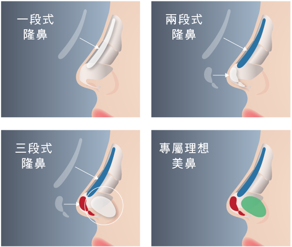 台北、桃園晶華醫美自體軟骨隆鼻手術推薦 多段結構式隆鼻
