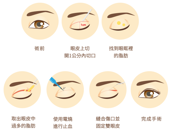 台北、桃園晶華醫美整型雙眼皮