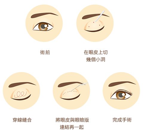 台北、桃園晶華醫美整型雙眼皮
