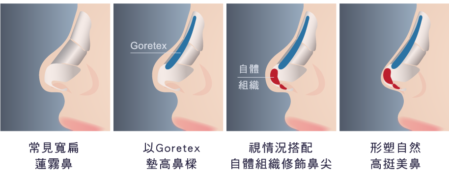 台北、桃園晶華醫美三段結構式隆鼻手術推薦  三段結構式隆鼻分段調整
