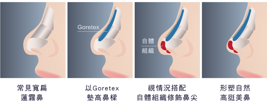 台北、桃園晶華醫美三段結構式隆鼻手術推薦 三段結構式隆鼻分段調整