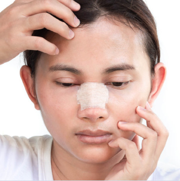 台北、桃園晶華醫美三段結構式隆鼻手術推薦 隆鼻材質選擇