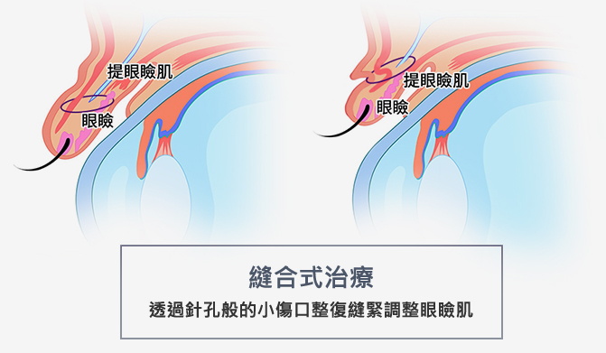 台北、桃園晶華醫美提眼瞼肌整形手術推薦 提眼瞼肌手術方式