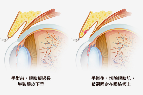 台北、桃園晶華醫美提眼瞼肌整形手術推薦 提眼瞼肌手術方式