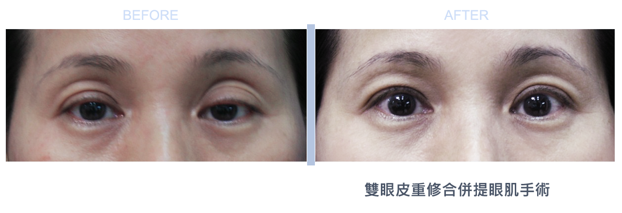 台北、桃園晶華醫美提眼瞼肌整形手術推薦 提眼瞼肌手術案例照片