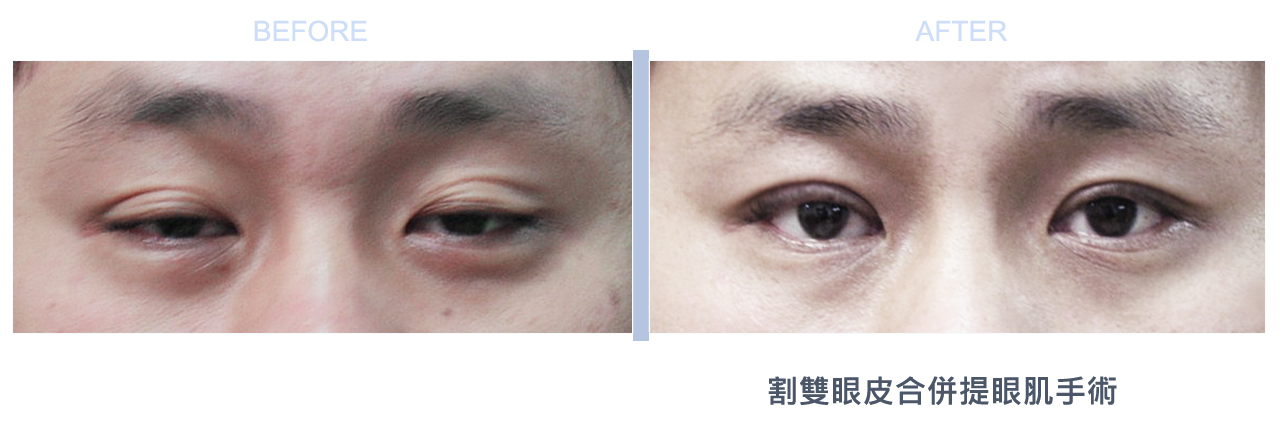 台北、桃園晶華醫美提眼瞼肌整形手術推薦 提眼瞼肌手術案例照片