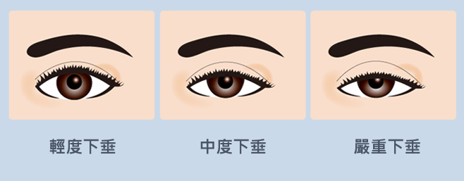 台北、桃園晶華醫美提眼瞼肌整形手術推薦 提眼瞼肌下垂程度