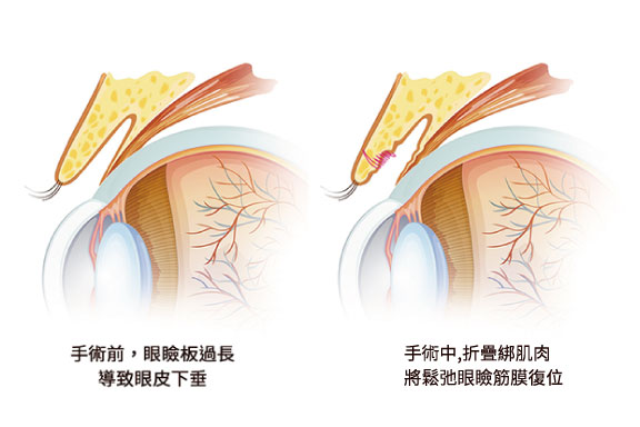 台北、桃園晶華醫美提眼瞼肌整形手術推薦 提眼瞼肌手術方式