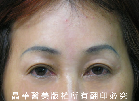 台北、桃園晶華醫美臉部拉皮整形手術推薦 內視鏡隱痕拉提手術案例照片