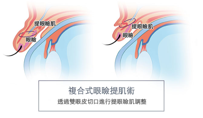 台北、桃園晶華醫美提眼瞼肌整形手術推薦 提眼瞼肌手術方式