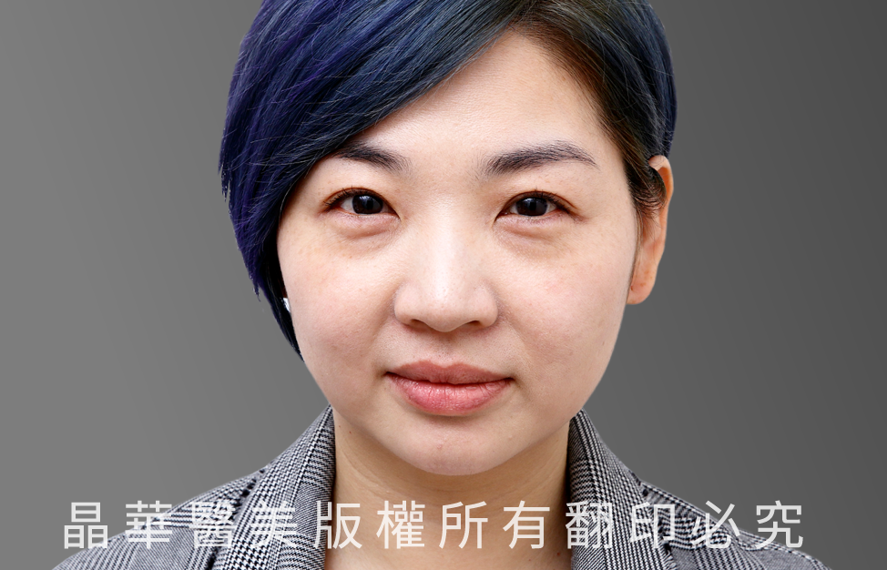 台北、桃園晶華醫美眼袋整形手術推薦 眼袋術前照片