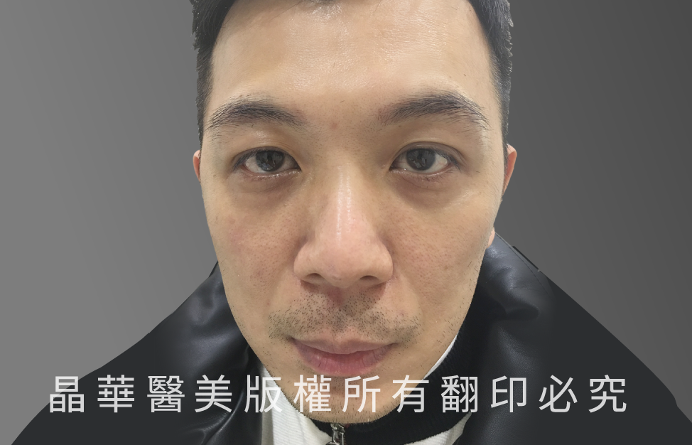 台北、桃園晶華醫美眼袋整形手術推薦 眼袋術前照片