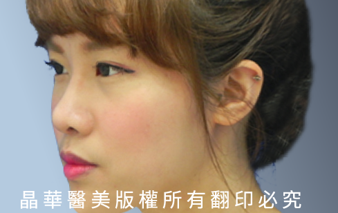 台北、桃園晶華醫美自體軟骨隆鼻手術推薦 自體軟骨隆鼻案例照片