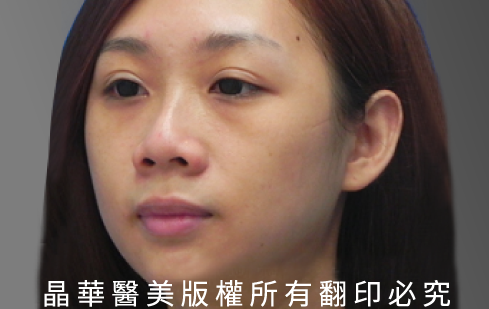 台北、桃園晶華醫美自體軟骨隆鼻手術推薦 自體軟骨隆鼻案例照片