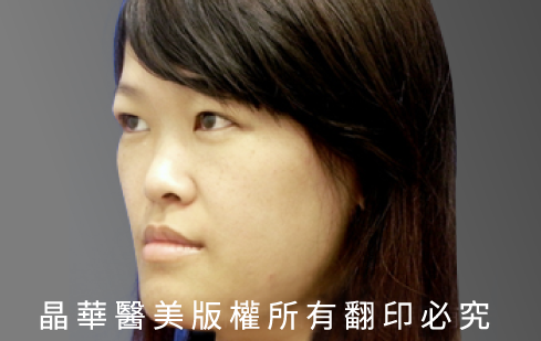 台北、桃園晶華醫美三段結構式隆鼻手術推薦  三段結構式隆鼻案例照片