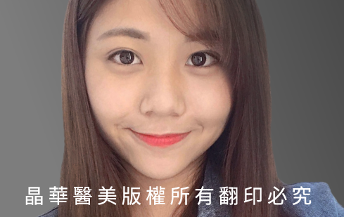 台北、桃園晶華醫美三段結構式隆鼻手術推薦  三段結構式隆鼻案例照片