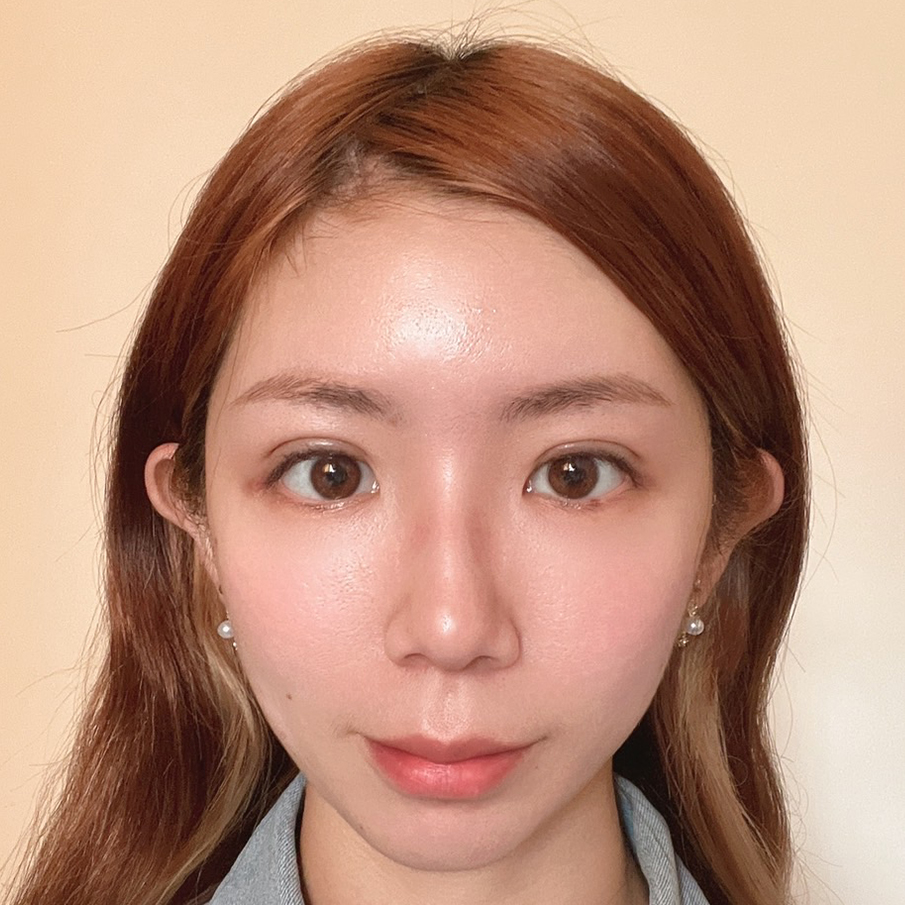 台北桃園晶華醫美隱痕提眉雙眼皮複合手術恢復過程(第14天)