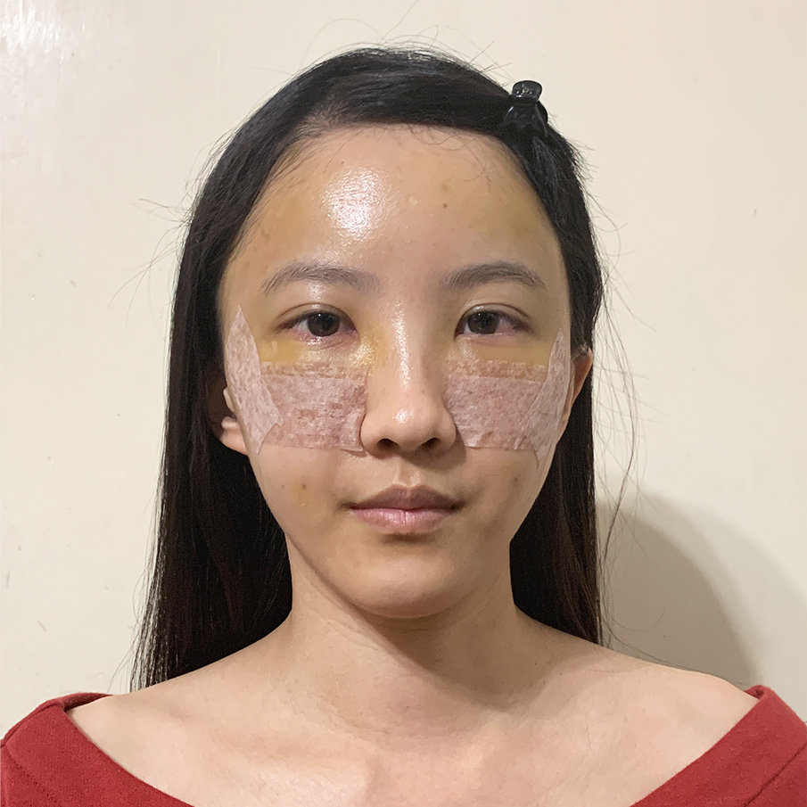 台北桃園晶華醫美隱痕眼袋合併自體脂肪全臉補脂手術恢復過程(第一天)