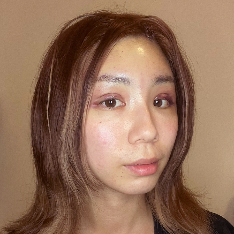 台北桃園晶華醫美隱痕提眉雙眼皮複合手術恢復過程(第一天)