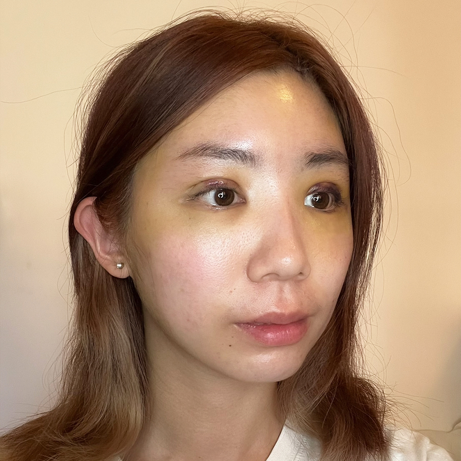 台北桃園晶華醫美隱痕提眉雙眼皮複合手術恢復過程(第七天)