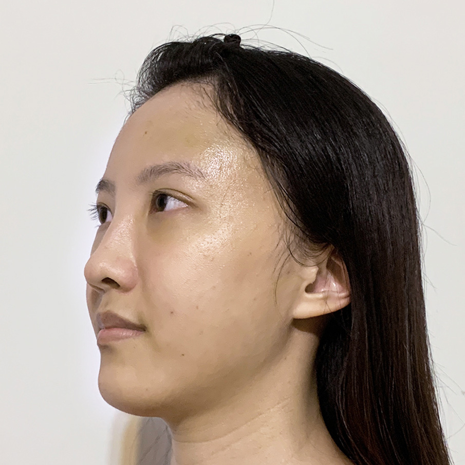 台北桃園晶華醫美隱痕眼袋合併自體脂肪全臉補脂手術恢復過程(第三天)