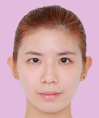 台北桃園晶華醫美隱痕提眉雙眼皮複合手術前(眼睛不對稱、一單一雙)
